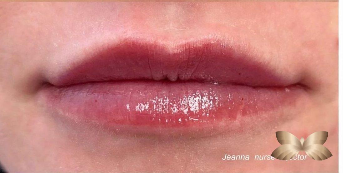 Lip Augmentation By: Jeanna