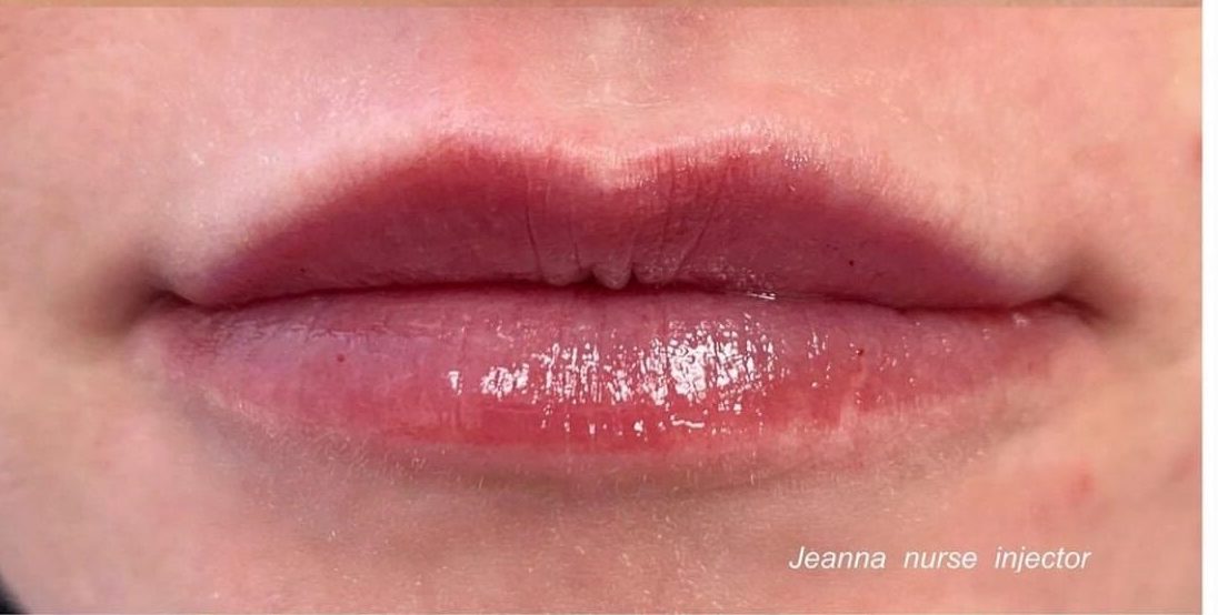 Lip Augmentation by UFP Nurse Injector Utah Facial Plastics