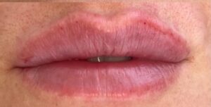 After Image: Lip Augmentation by: UFP Nurse Injector
