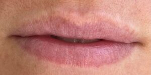 Before Image: Lip Augmentation by: UFP Nurse Injector
