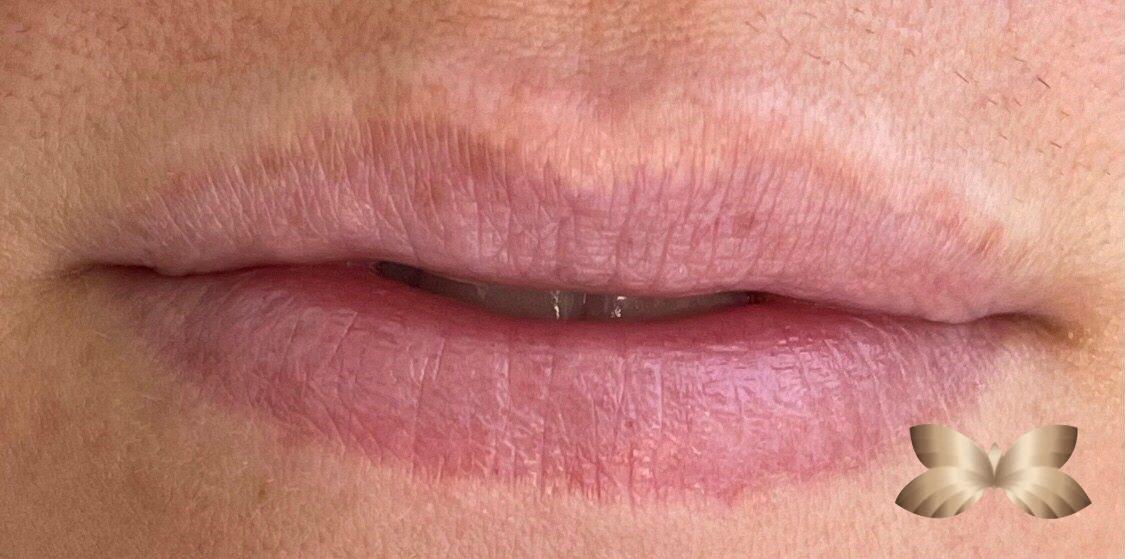 Lip Augmentation by: UFP Nurse Injector