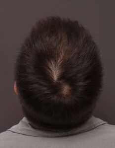 Hair Injection Therapy by: UFP Nurse