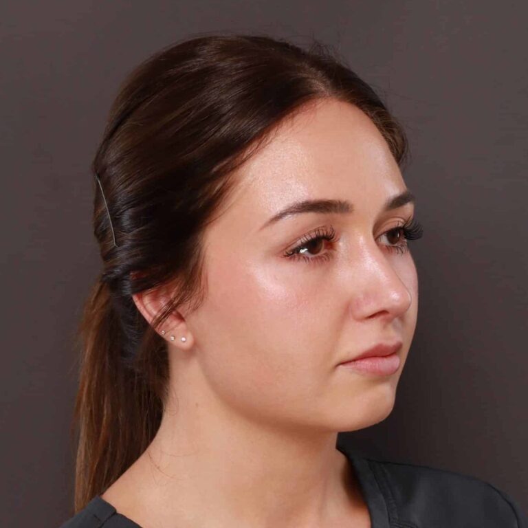 After Image: Rhinoplasty by: Dr. Thompson - right-front-oblique