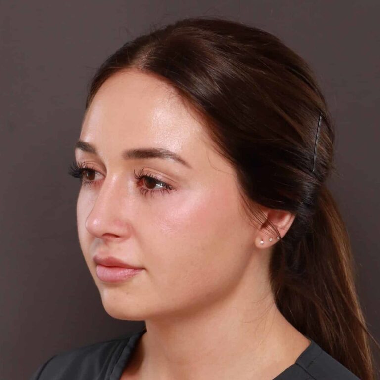 After Image: Rhinoplasty by: Dr. Thompson - left-front-oblique