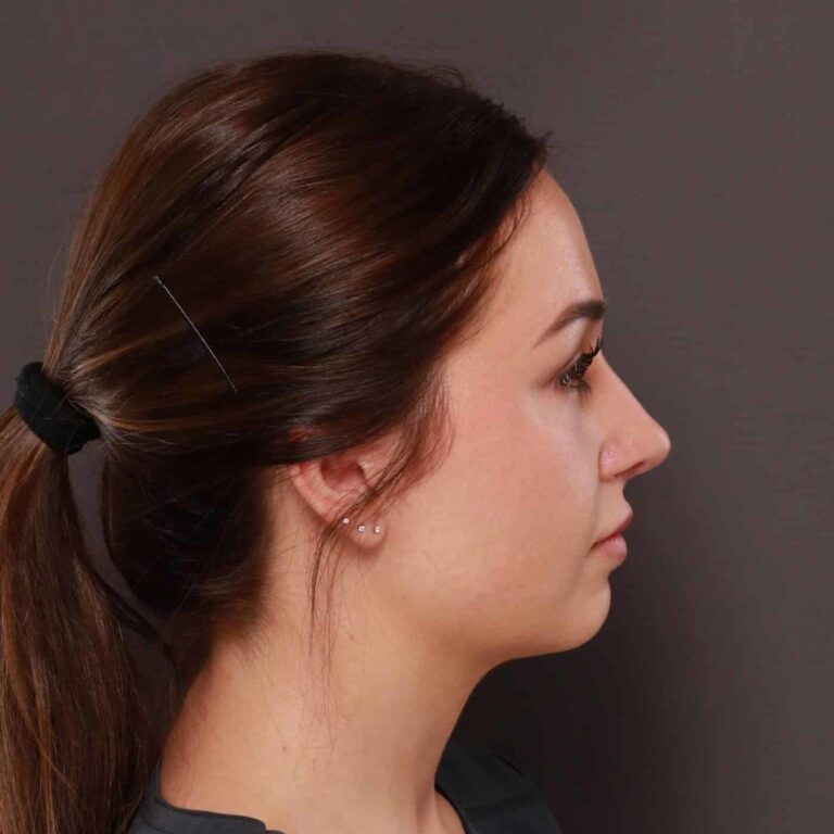 After Image: Rhinoplasty by: Dr. Thompson - right-side