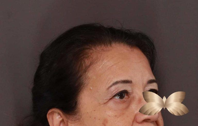 Before Image: Upper Eyelid Lift by: Dr. Henstrom - right-front-oblique