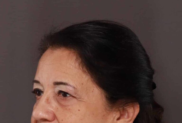 Before Image: Upper Eyelid Lift by: Dr. Henstrom - left-front-oblique