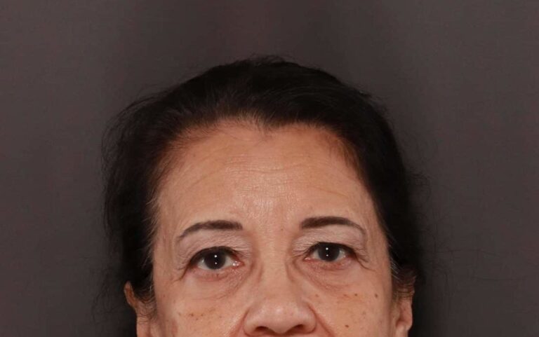 Before Image: Upper Eyelid Lift by: Dr. Henstrom - front