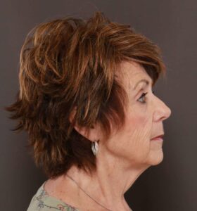 Facelift and Contour TRL by: Dr. Thompson/Katy Larson