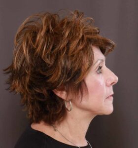 Facelift and Contour TRL by: Dr. Thompson/Katy Larson