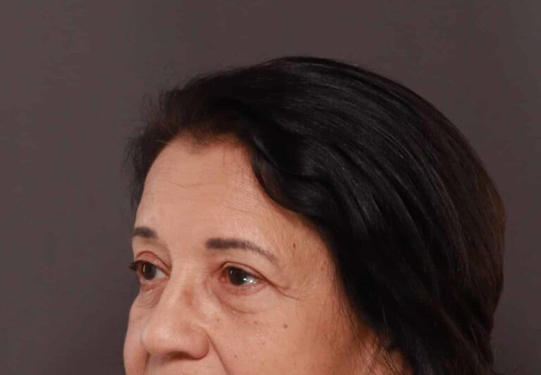 After Image: Upper Eyelid Lift by: Dr. Henstrom - left-front-oblique