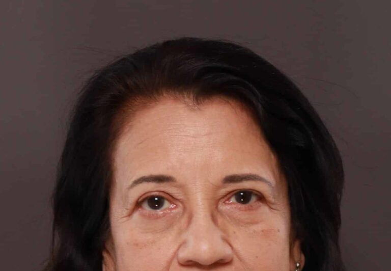 After Image: Upper Eyelid Lift by: Dr. Henstrom - front