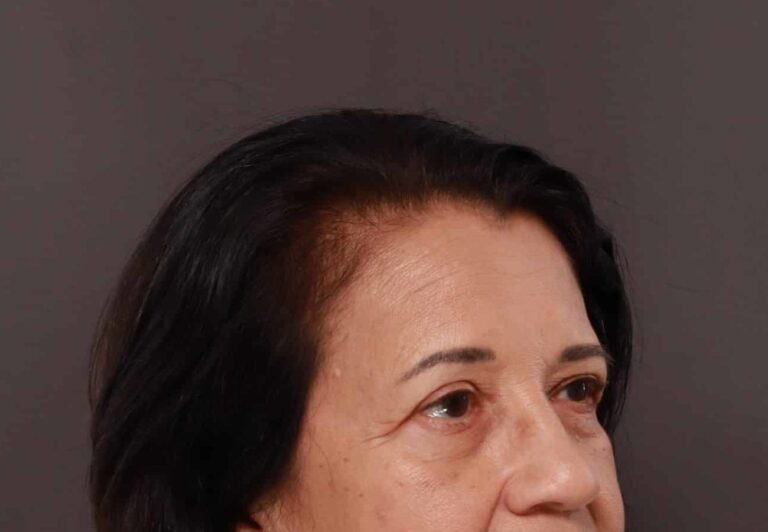 After Image: Upper Eyelid Lift by: Dr. Henstrom - right-front-oblique