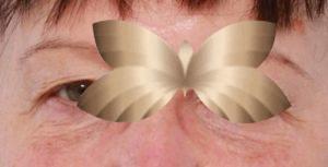 Upper Eyelid lift and Laser Resurfacing by: Dr. Henstrom