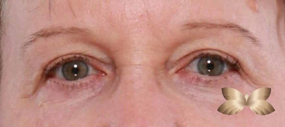 Upper Eyelid lift and Laser Resurfacing by: Dr. Henstrom