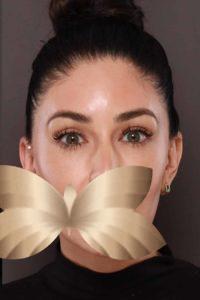 Dermal Filler by: Kayla
