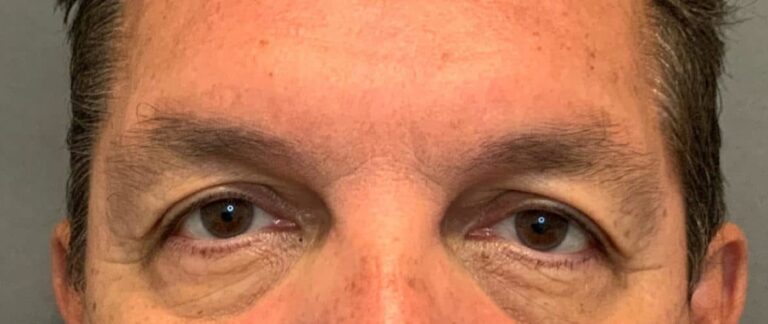Before Image: Upper Eyelid Lift by: Dr. Thompson - front