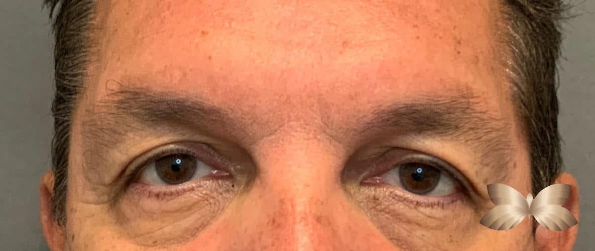 Upper Eyelid Lift by: Dr. Thompson