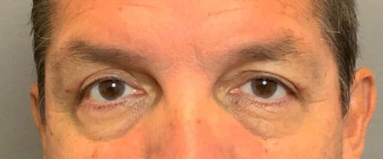 After Image: Upper Eyelid Lift by: Dr. Thompson - front