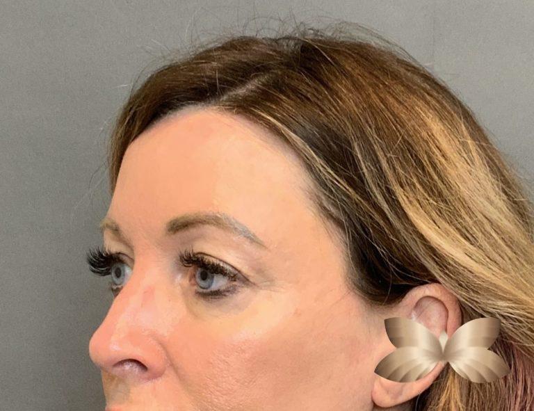 Before Image: Upper Eyelid Lift and Fat Grafting by: Dr. Thompson - left-front-oblique