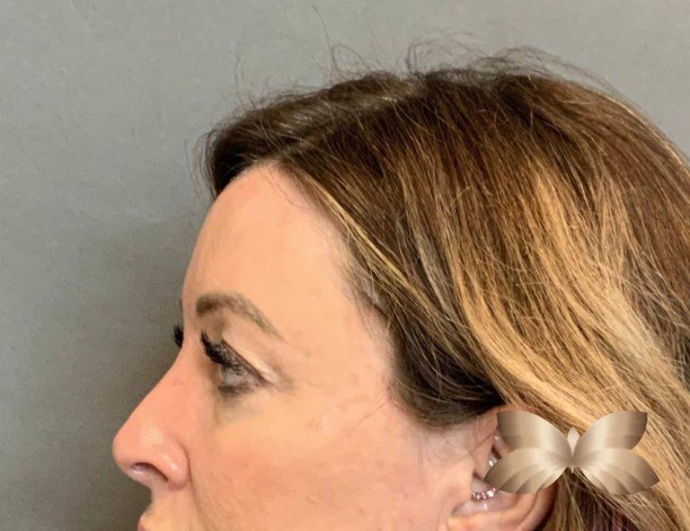 Before Image: Upper Eyelid Lift and Fat Grafting by: Dr. Thompson - left-side