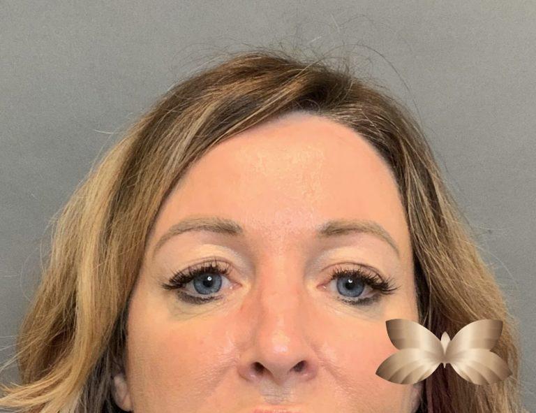 Before Image: Upper Eyelid Lift and Fat Grafting by: Dr. Thompson - front
