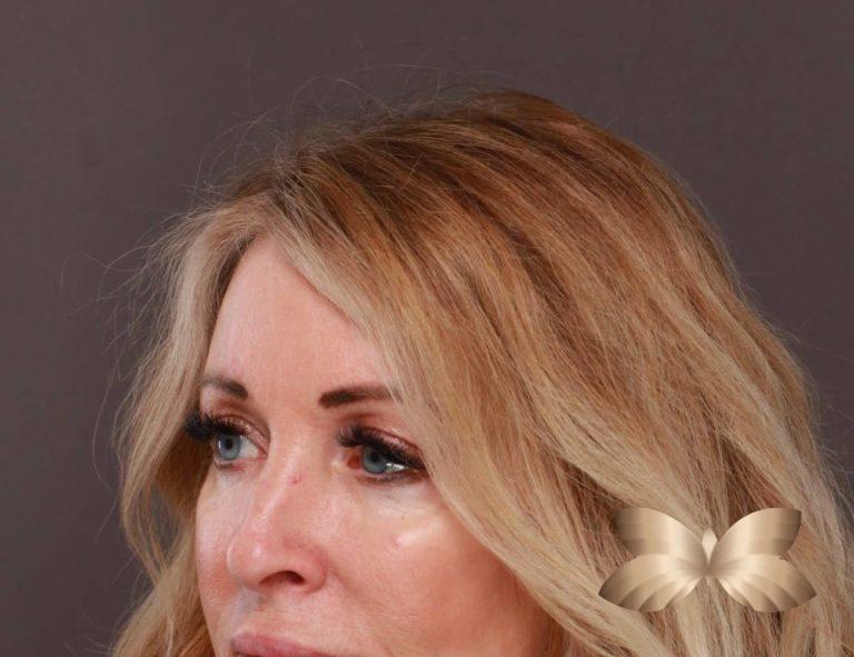 After Image: Upper Eyelid Lift and Fat Grafting by: Dr. Thompson - left-front-oblique