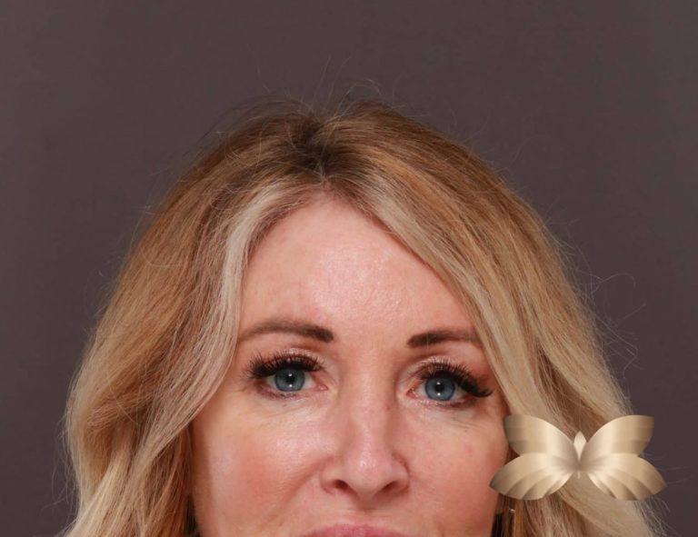 After Image: Upper Eyelid Lift and Fat Grafting by: Dr. Thompson - front