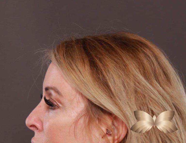 After Image: Upper Eyelid Lift and Fat Grafting by: Dr. Thompson - left-side