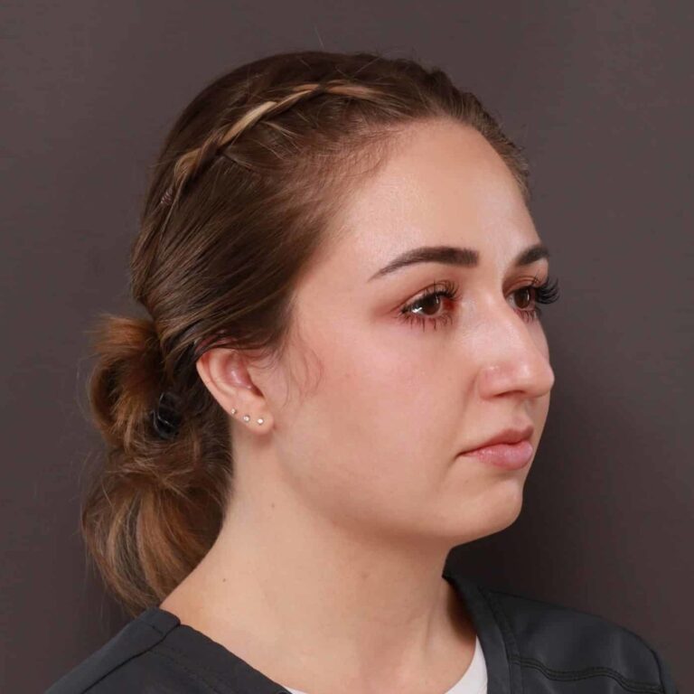 Before Image: Rhinoplasty by: Dr. Thompson - right-front-oblique