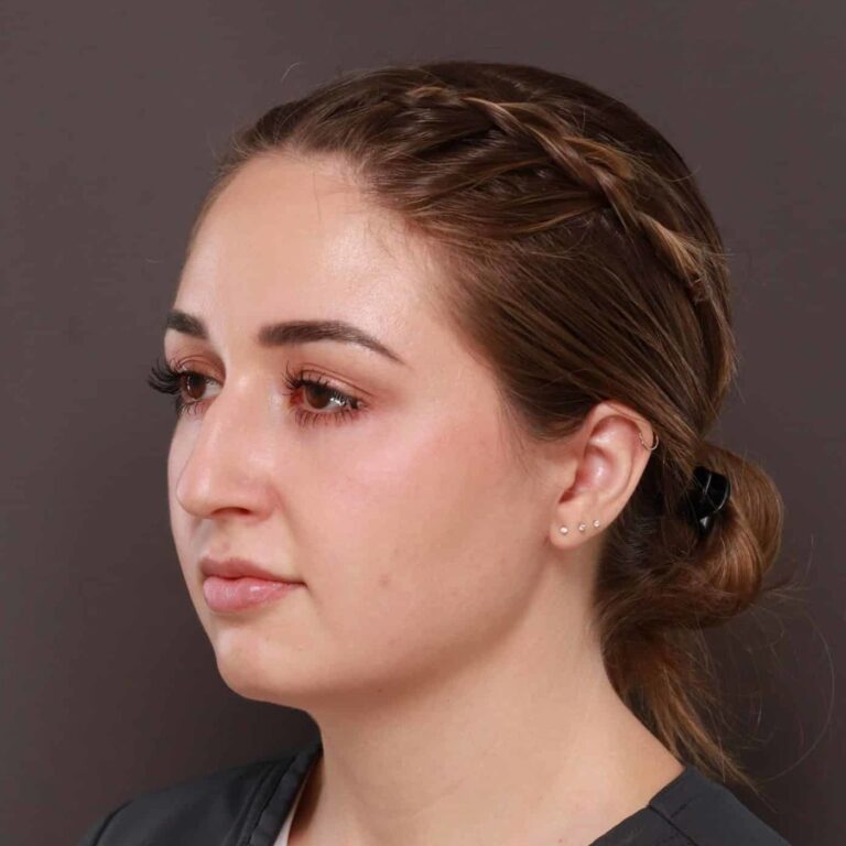 Before Image: Rhinoplasty by: Dr. Thompson - left-front-oblique