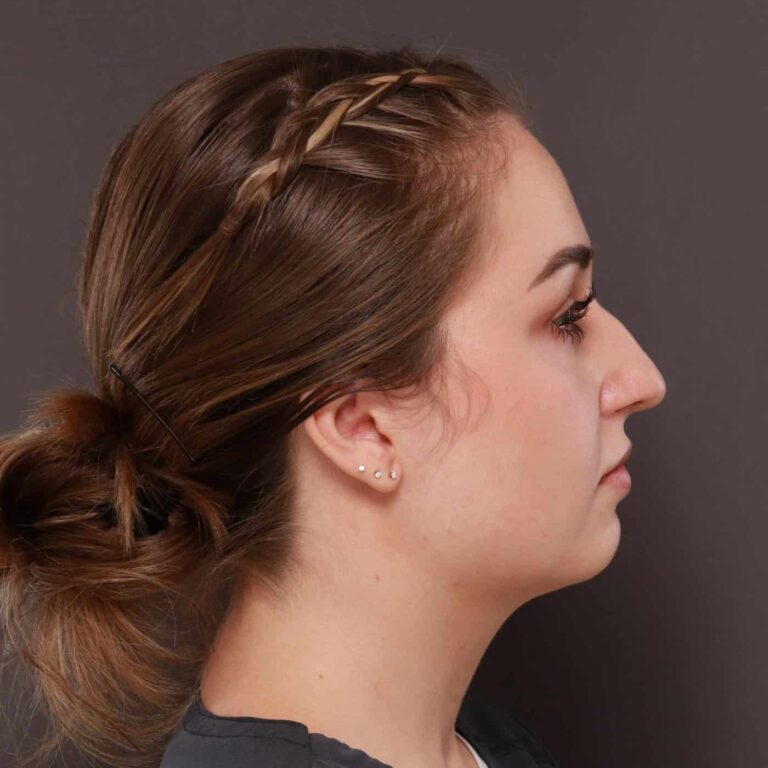 Before Image: Rhinoplasty by: Dr. Thompson - right-side