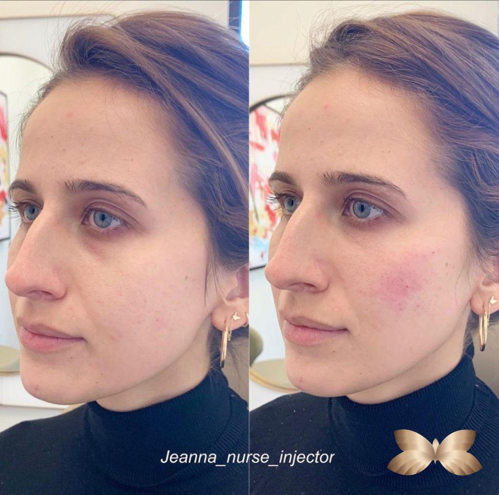 Tired Eyes? Eyelid Rejuvenation Options For Everyone Utah Facial Plastics