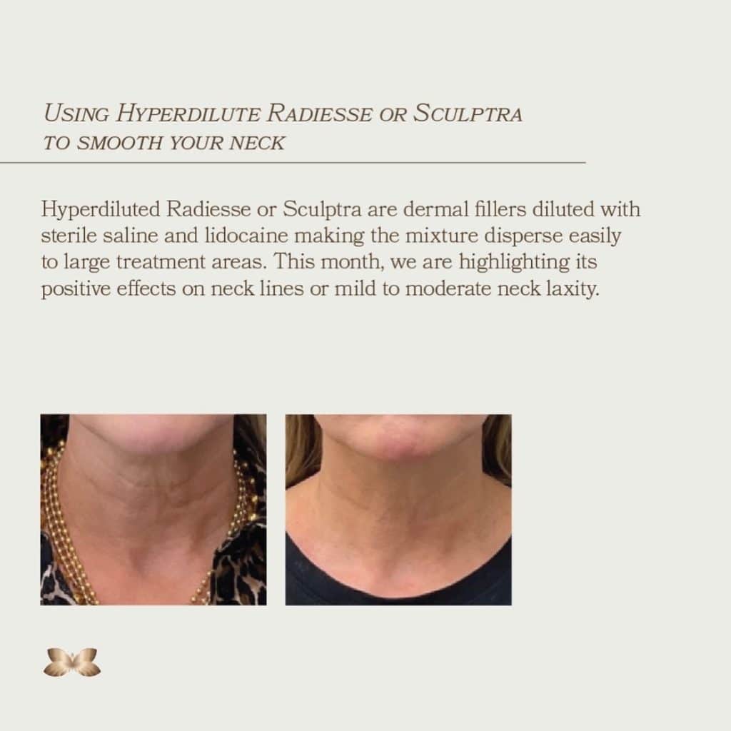 Radiesse Neck Treatment Radiesse Neck Treatment