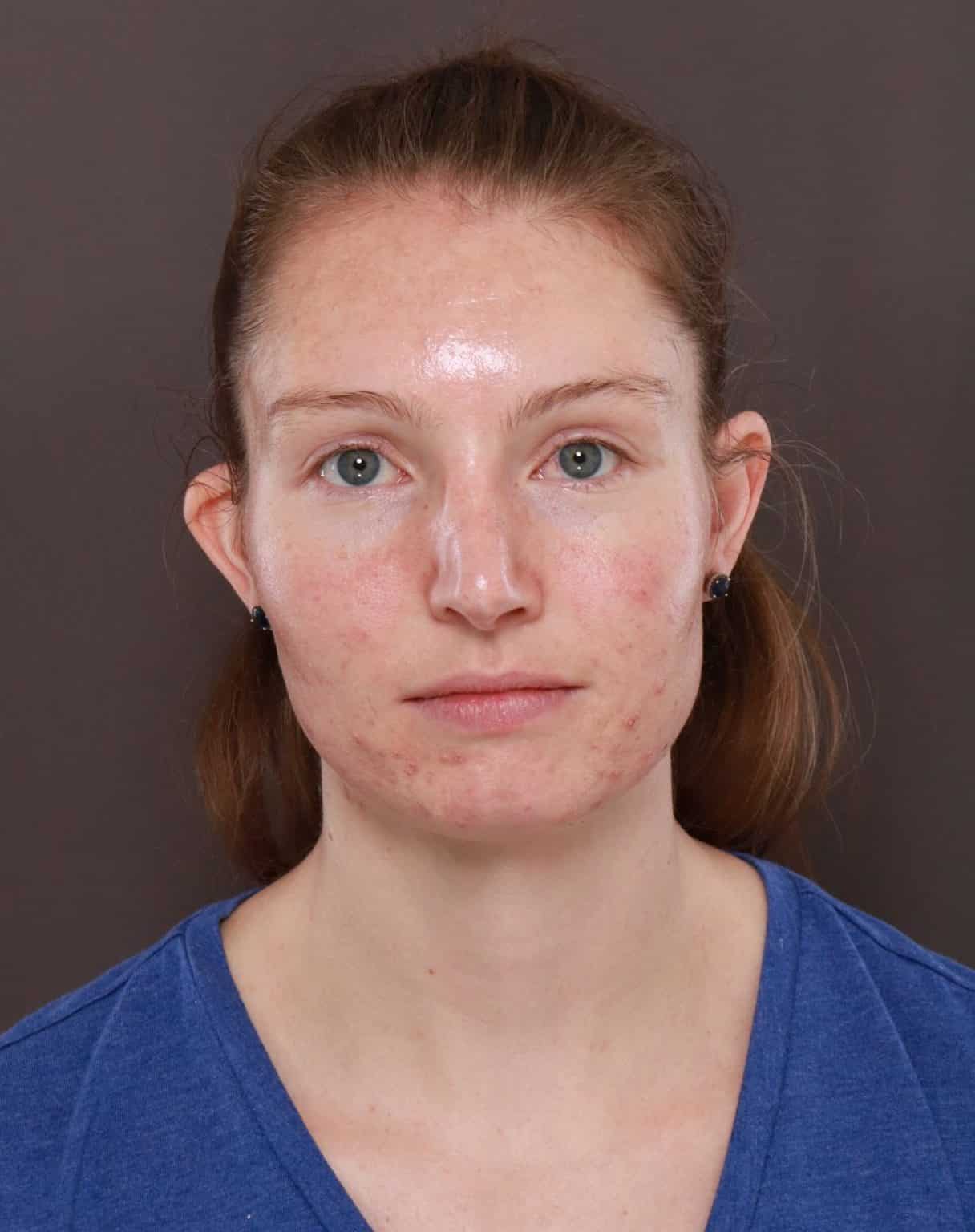 Septorhinoplasty By: Dr. Henstrom - Utah Facial Plastics