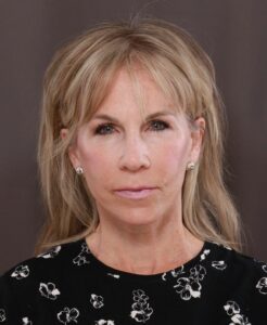 Facelift & Browlift by Dr. Thompson