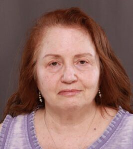 Lower Blepharoplasty with Fat Repositioning & Perioral Dermabrasion by Dr. Manning
