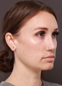 Earlobe Repair by Dr. Manning