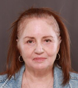 Lower Blepharoplasty with Fat Repositioning & Perioral Dermabrasion by Dr. Manning