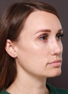 Earlobe Repair by Dr. Manning