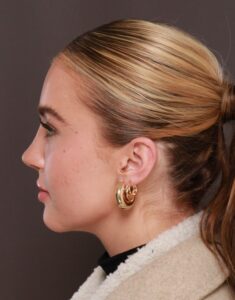 Rhinoplasty by Dr. Manning