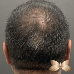 Hair Loss Treatment with Acell