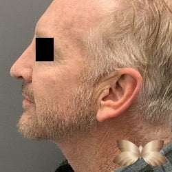 Necklift and Rhinoplasty by Dr. Henstrom