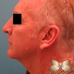 Necklift and Rhinoplasty by Dr. Henstrom