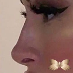After Image: Non- Surgical Rhinoplasty - other