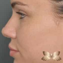 Non-Surgical Rhinoplasty by Dr. Henstrom