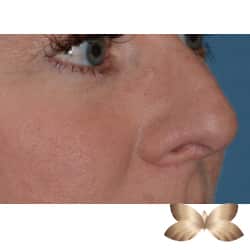 Non-Surgical Rhinoplasty by Dr. Henstrom