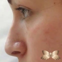 Before Image: Non- Surgical Rhinoplasty - other