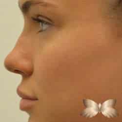 Non-Surgical Rhinoplasty by Dr. Henstrom