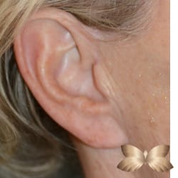 Earlobe Repair by Dr. Thompson